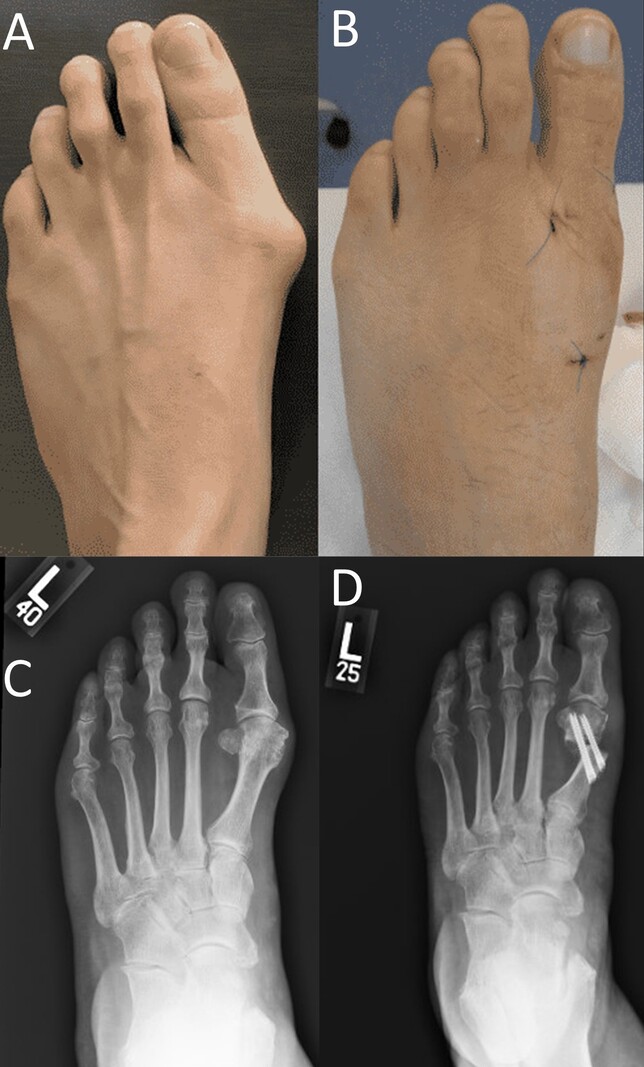 Cirurgia e resultado final
