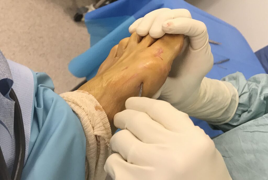 Cirurgia percutânea - através de furos