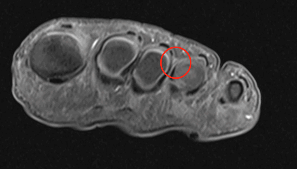 Foto Neuroma